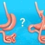 Differences between Gastric Surgery and Gastric Bypass