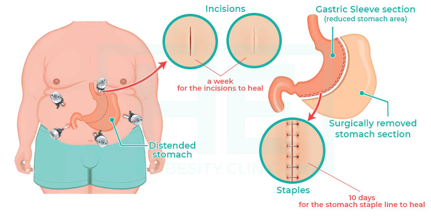 how is the recovery process after gastric sleeve surgery3