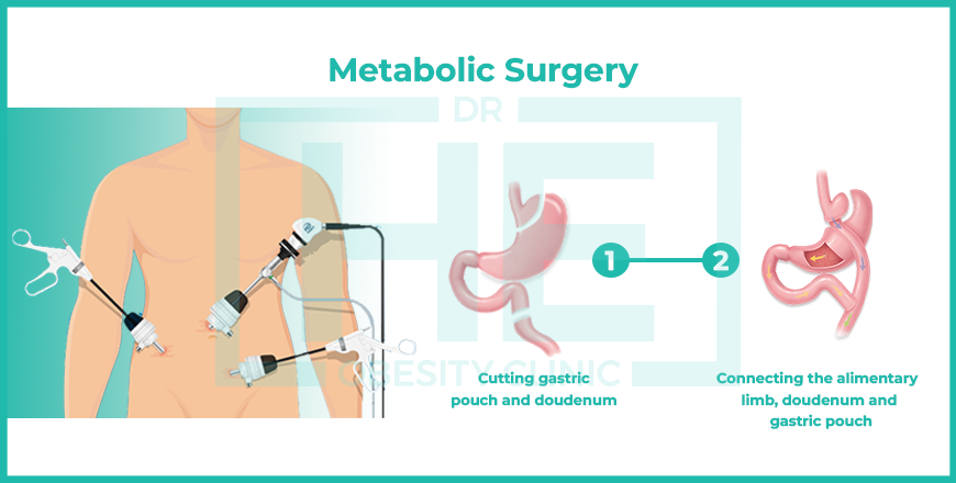 Metabolic surgery