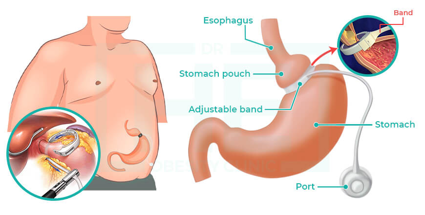 What is Gastric Band 1