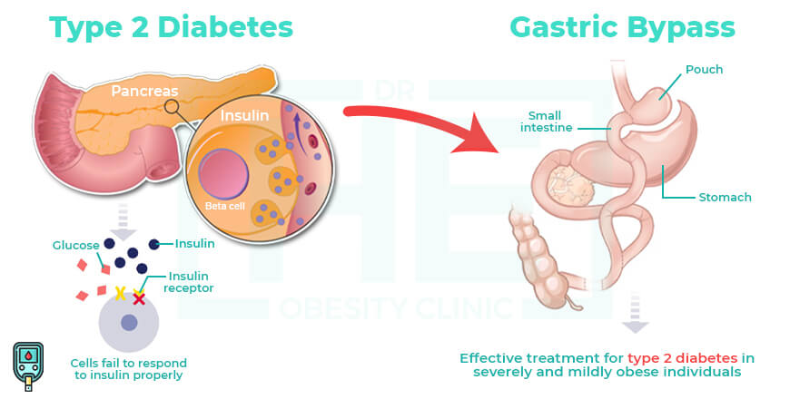Which Surgery is Used As Type 2 Diabetes Treatment 1