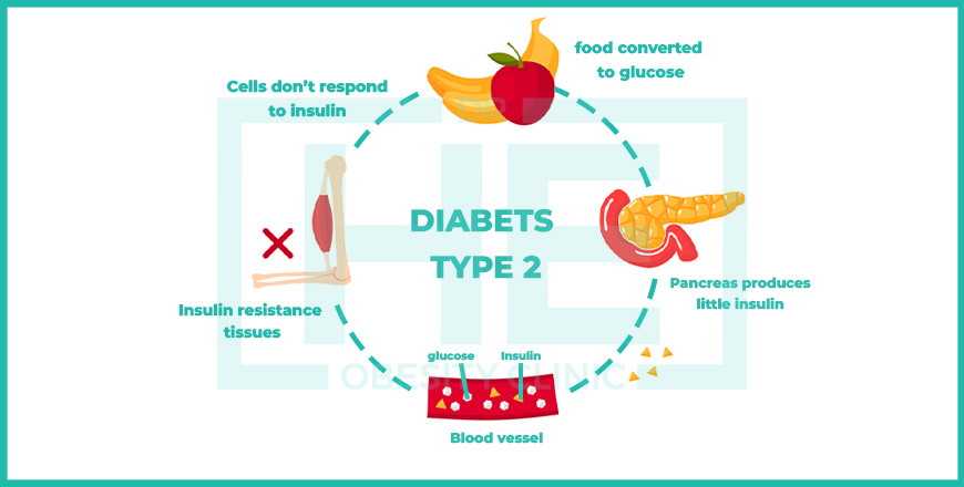 what is diabet type 2
