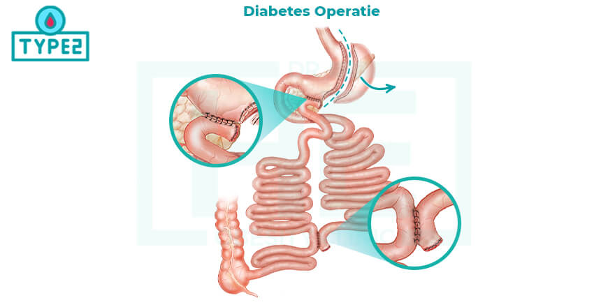 hoe wordt de chirurgie van de diabetes uitgevoerd