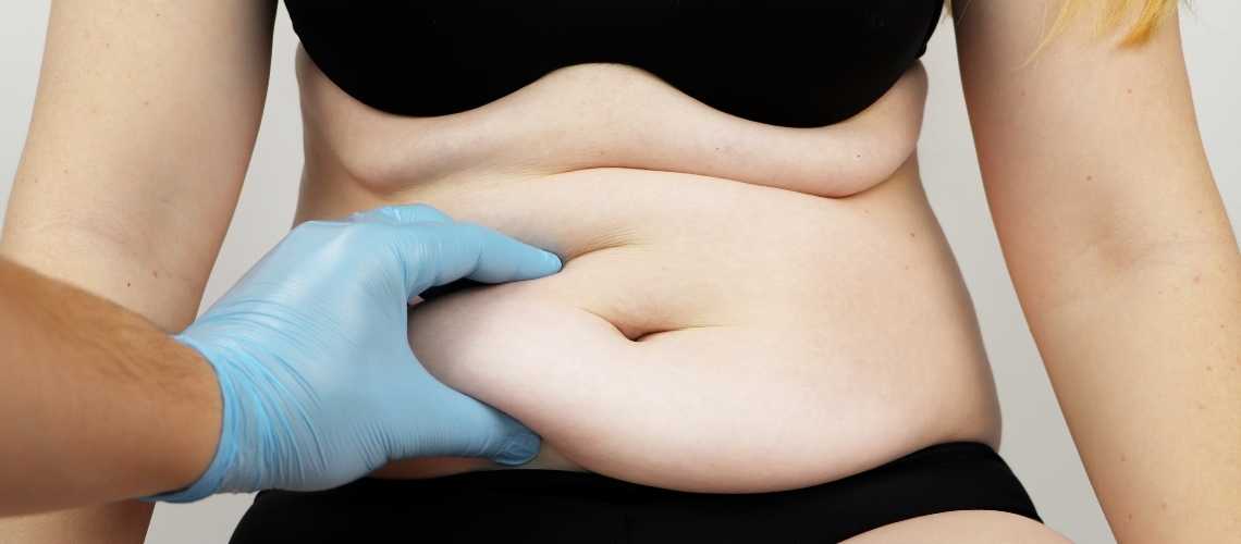 When Should Post Bariatric Liposuction Be Scheduled