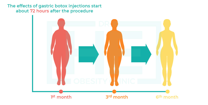 How Long Last The Effects Of Gastric Botox Injections