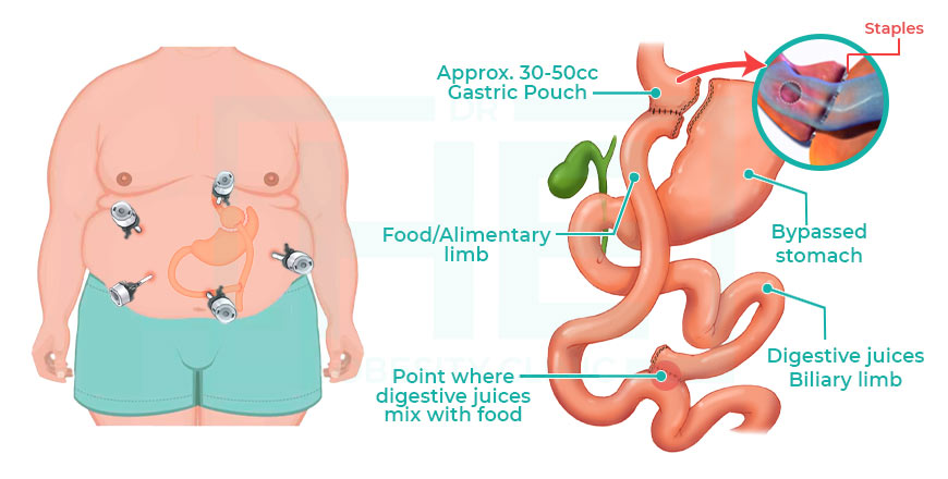 How Rny gastric bypass is done