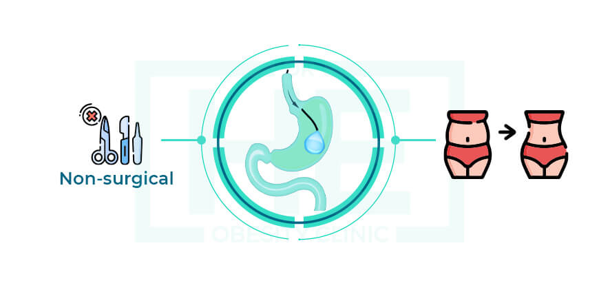 What Are The Advantages Of Intragastric Balloon 1