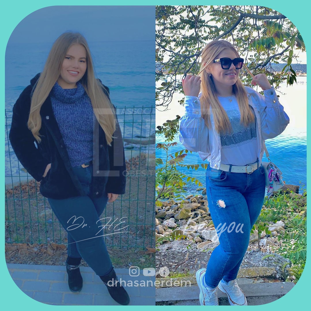before and after gastric bypass women