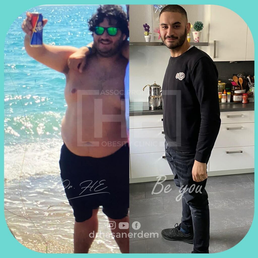 before and after roux en y gastric bypass