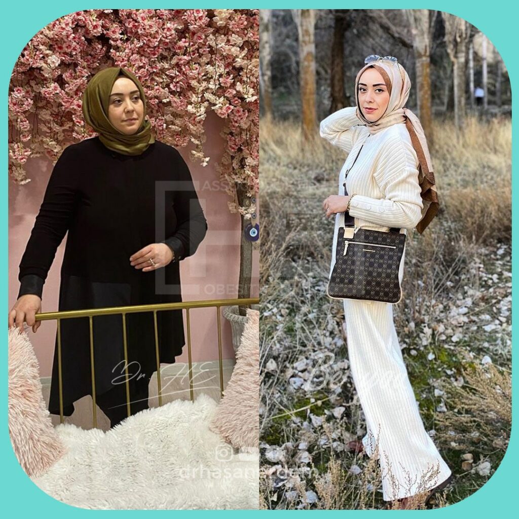 female gastric bypass before and after muslim women