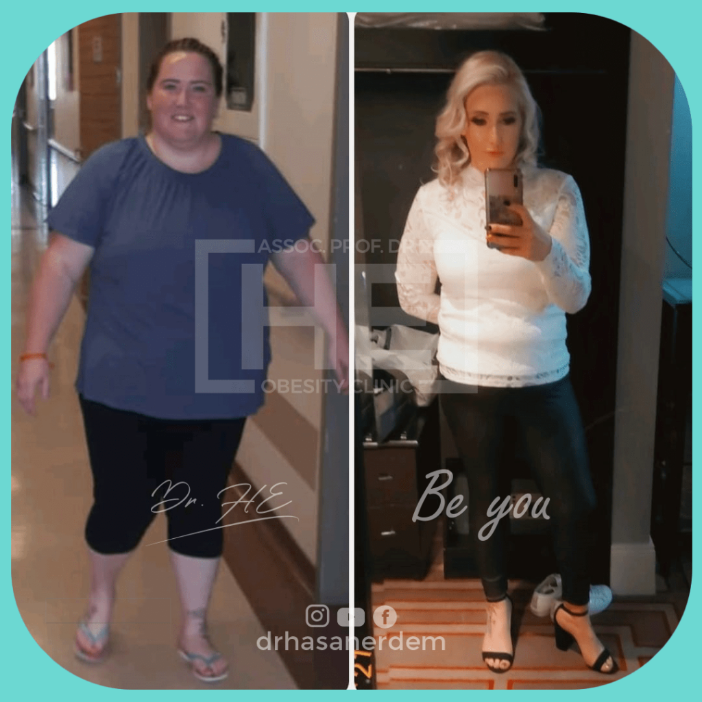 gastric bypass before after 50 kg