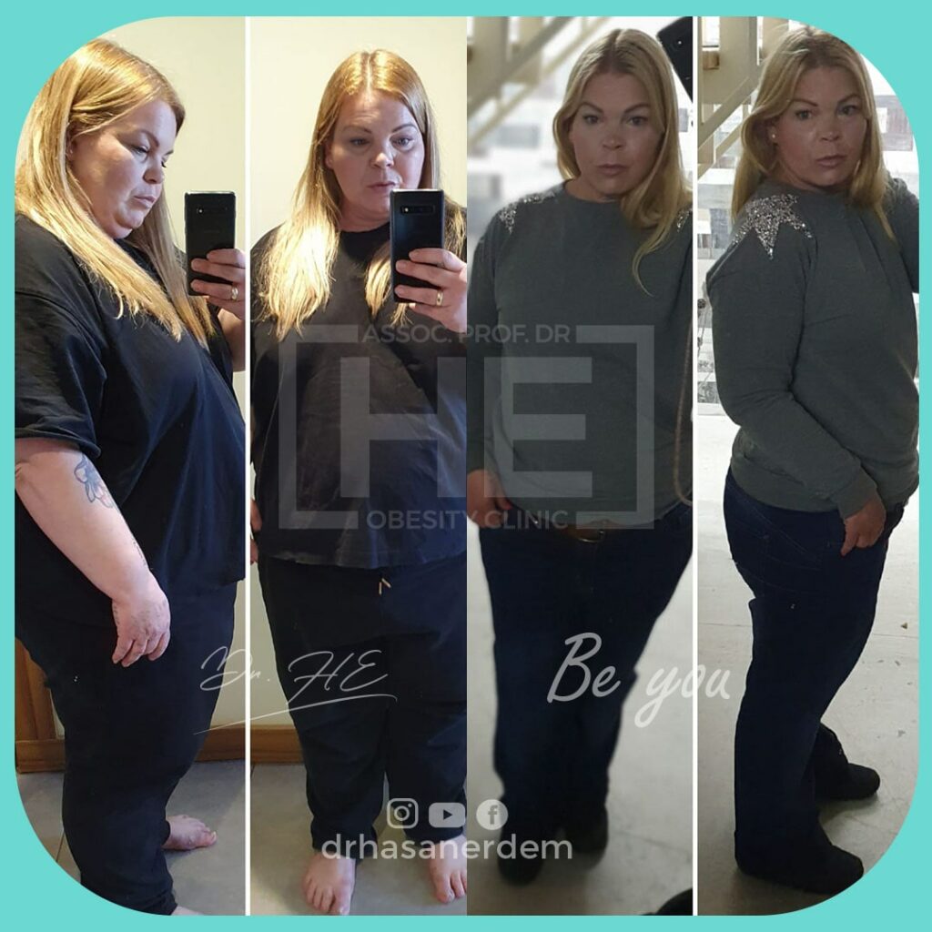gastric bypass before after butt