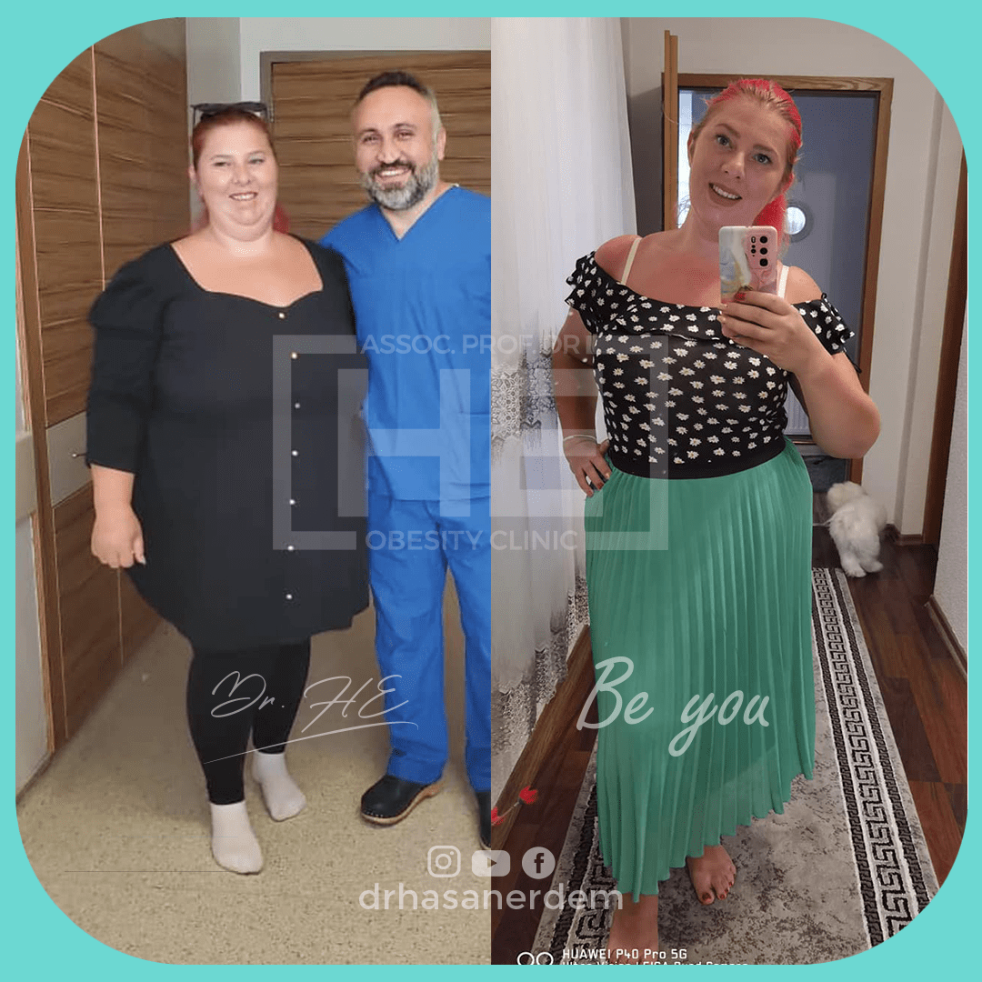 gastric bypass before after more than 50 kg redhead female