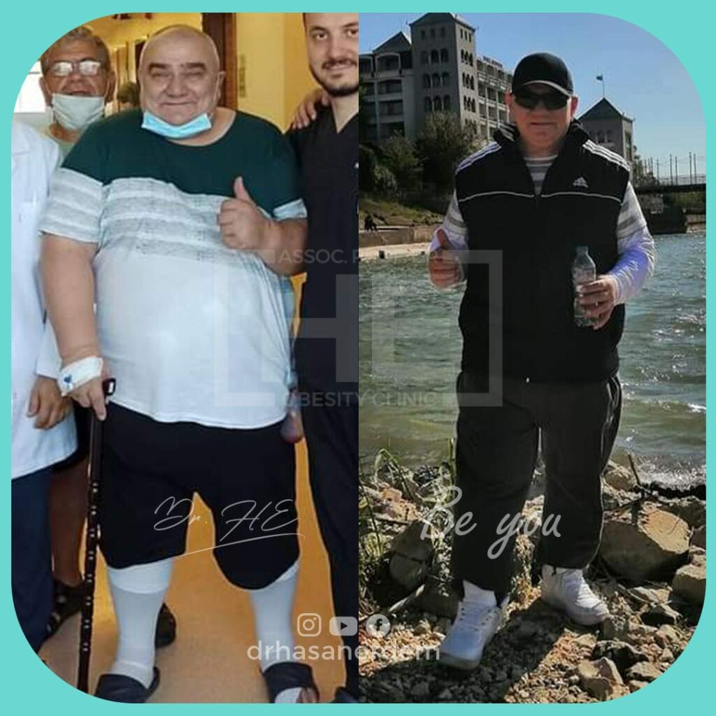 gastric bypass before and after men