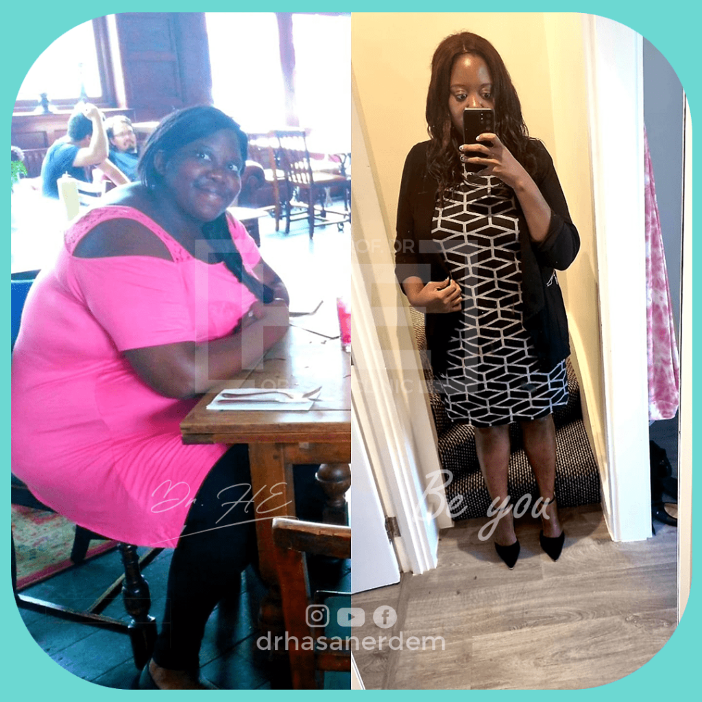 gastric bypass before and after pic black young women