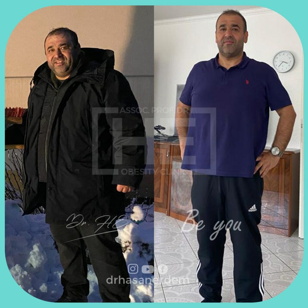 gastric bypass male before and after