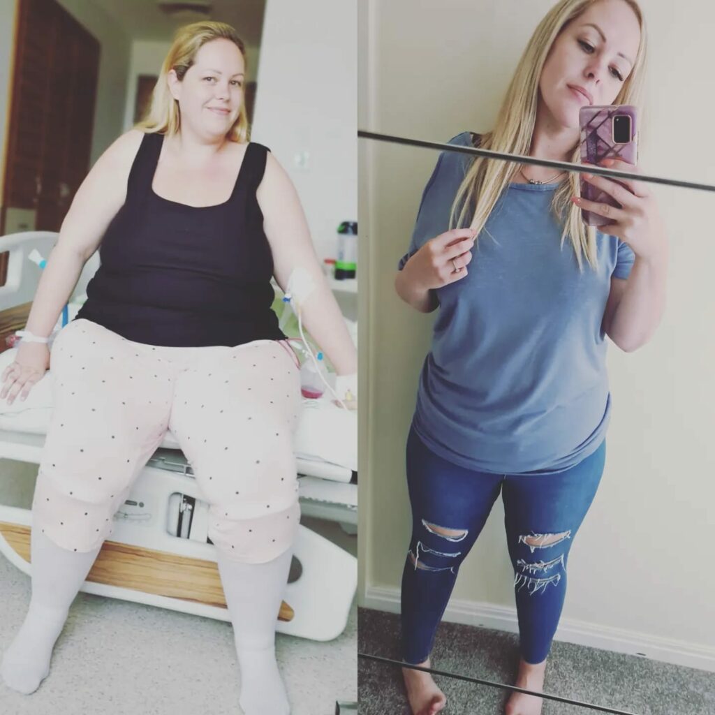 insane before and after gastric bypass