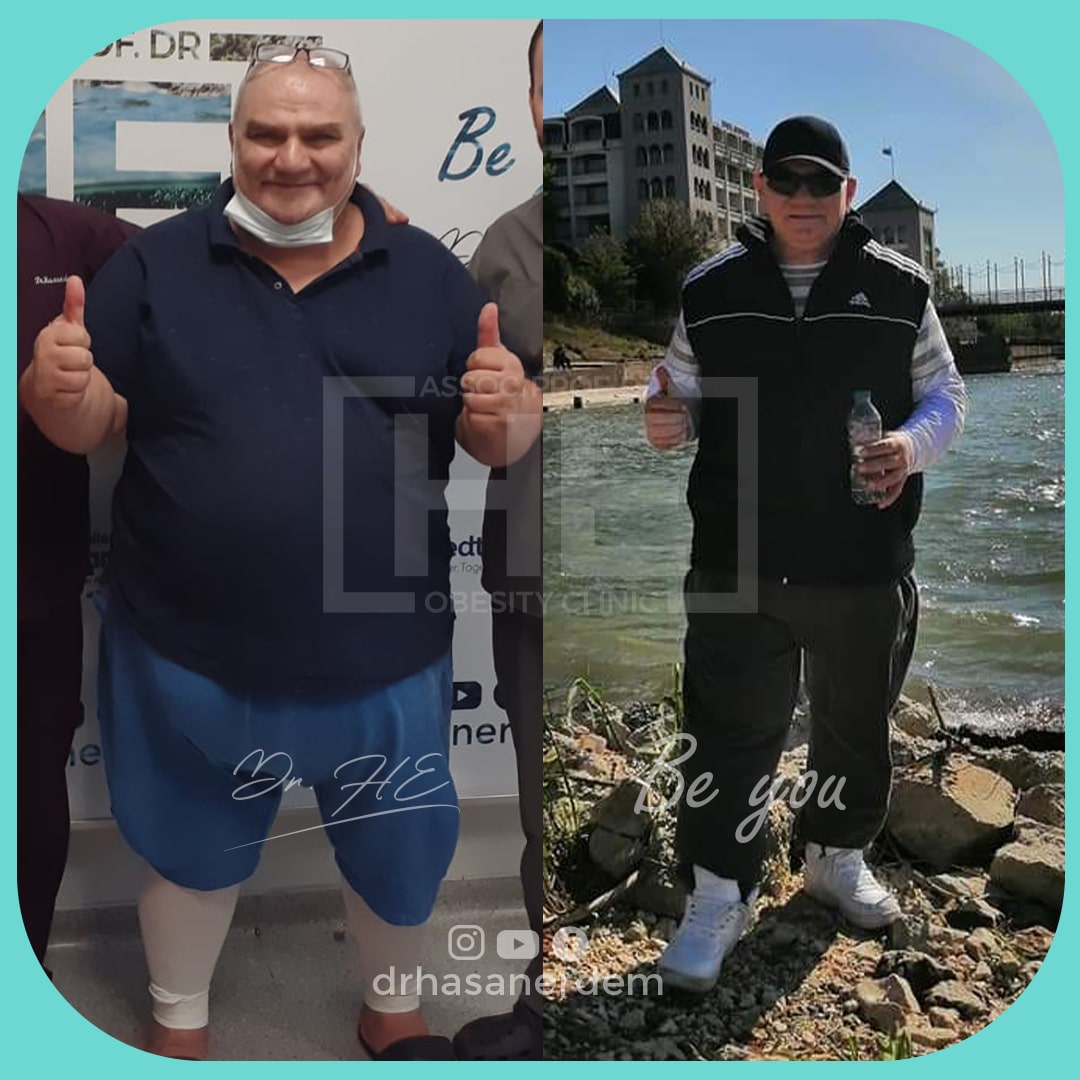 male gastric bypass surgery before and after