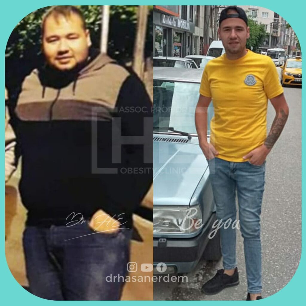 men's gastric bypass before and after