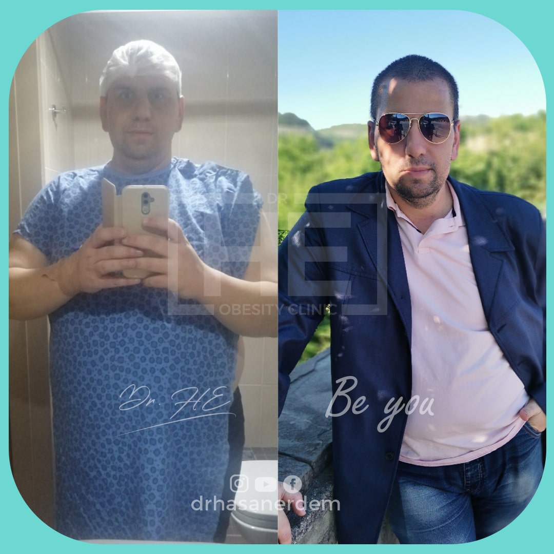 obalon gastric balloon before and after pictures