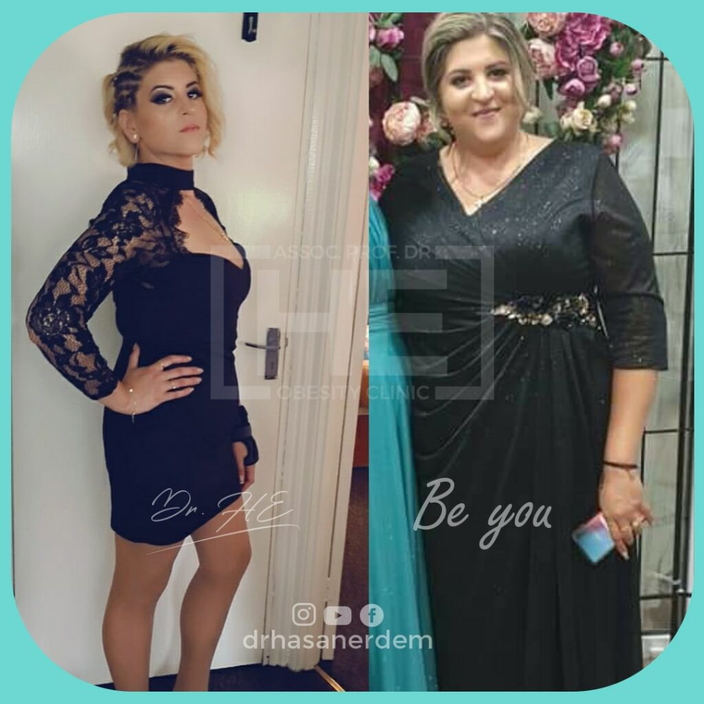 rny gastric bypass before and after