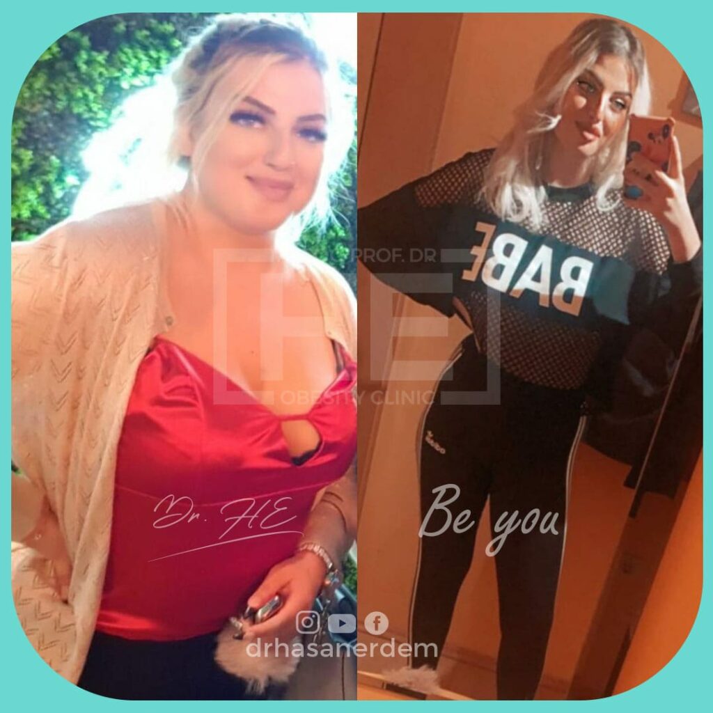 roux-en-y gastric bypass before and after