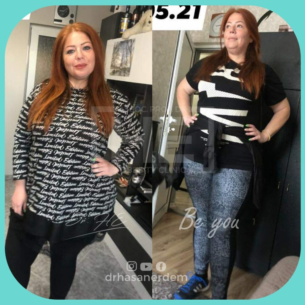 weight loss before and after weight loss gastric bypass redhead women
