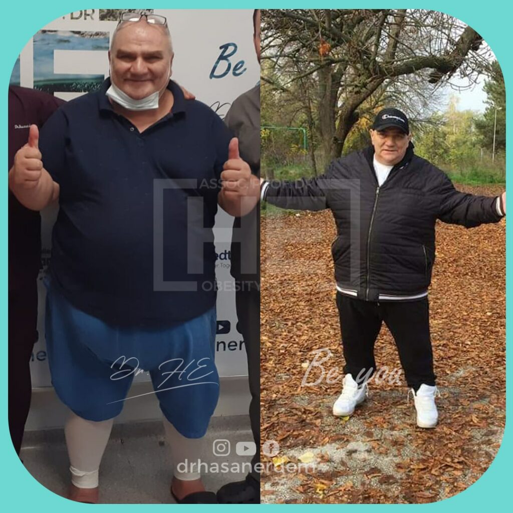 weight loss gastric bypass before and after old men