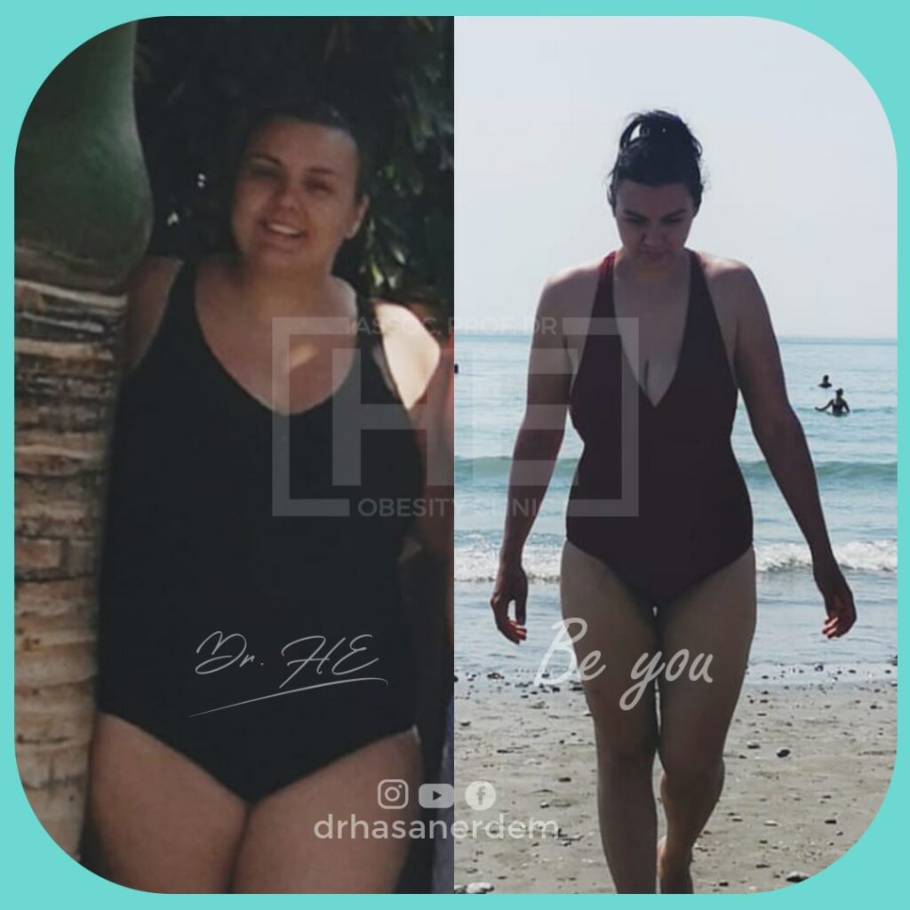 young women before and after gastric bypass