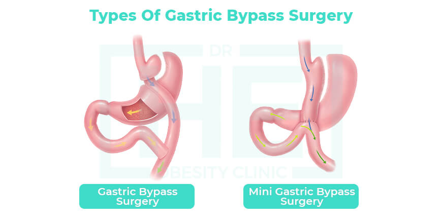 gastric bypass surgery types