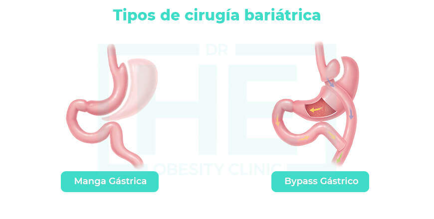 Tipos de cirugia bariatrica